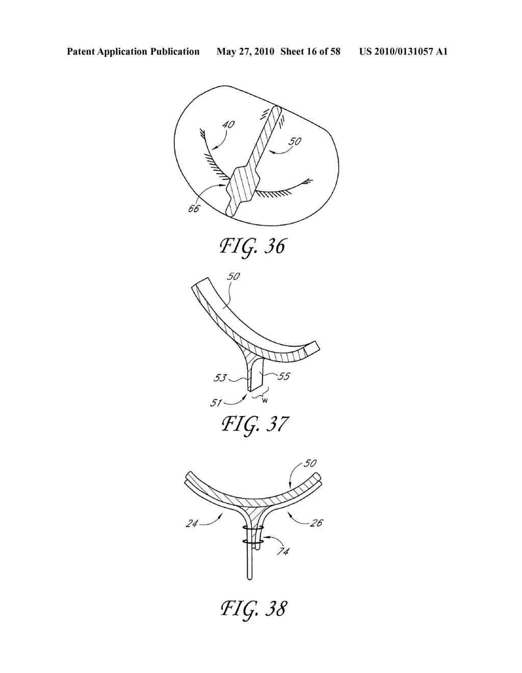 TRANSVALVULAR INTRAANNULAR BAND FOR AORTIC VALVE REPAIR - diagram, schematic, and image 17