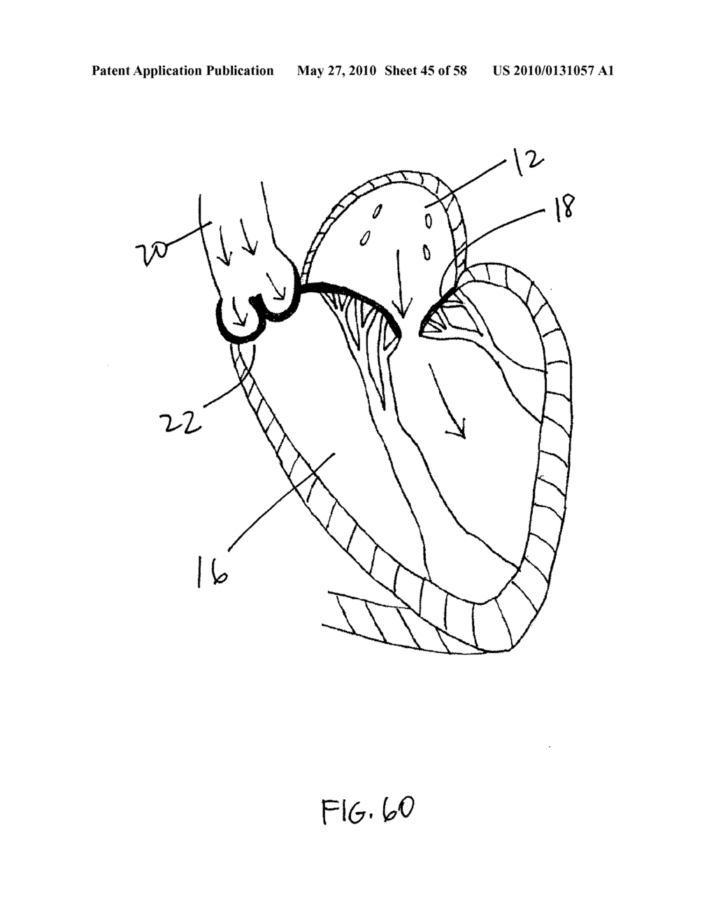 TRANSVALVULAR INTRAANNULAR BAND FOR AORTIC VALVE REPAIR - diagram, schematic, and image 46