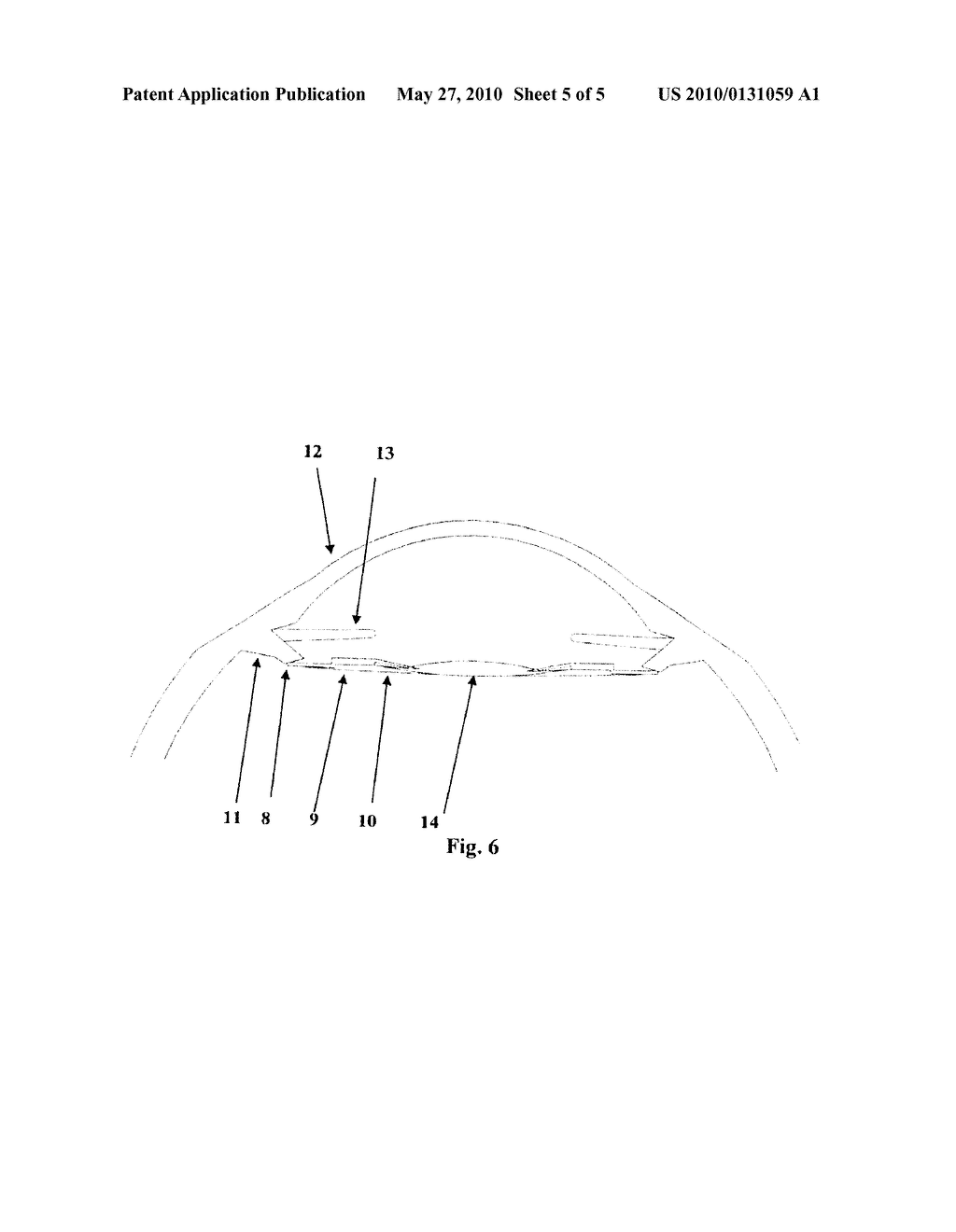 INTRAOCULAR LENS OPTIC - diagram, schematic, and image 06