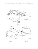 METHOD AND SYSTEM FOR PATELLA TENDON REALIGNMENT diagram and image