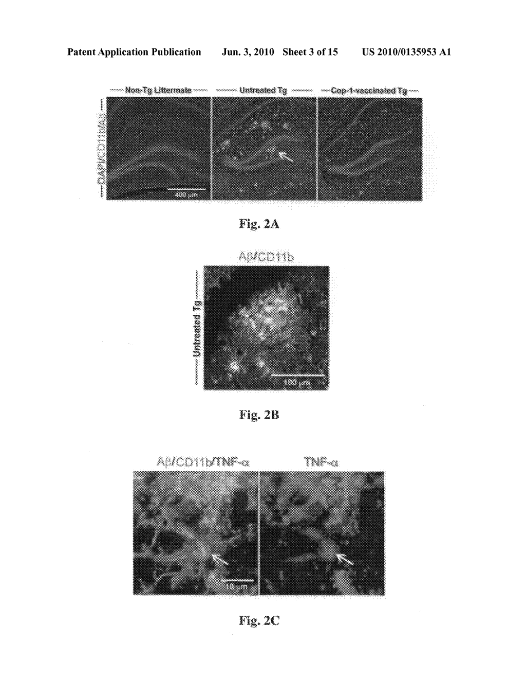 Method of treatment of age-related macular degeneration - diagram, schematic, and image 04