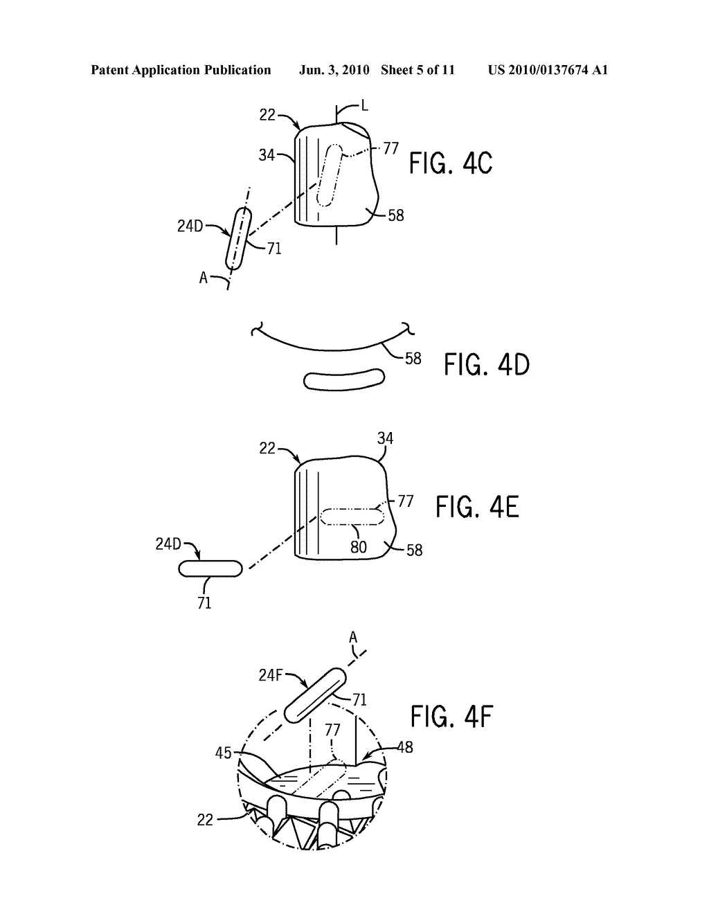 BRACHYTHERAPY TREATMENT OF THE SPINE WITH IRRADIATED IMPLANTS - diagram, schematic, and image 06