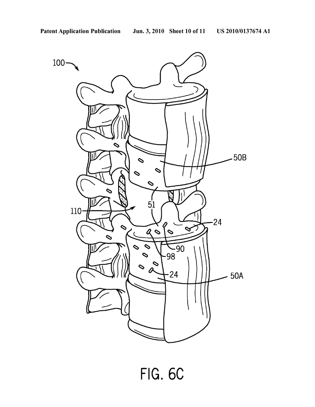 BRACHYTHERAPY TREATMENT OF THE SPINE WITH IRRADIATED IMPLANTS - diagram, schematic, and image 11