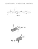 MINIMALLY INVASIVE BREAST LIFT METHOD WITH A SUPERIOR TISSUE SUPPORT AND AN INFERIOR ANCHOR diagram and image