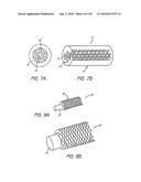 MINIMALLY INVASIVE BREAST LIFT METHOD WITH A SUPERIOR TISSUE SUPPORT AND AN INFERIOR ANCHOR diagram and image