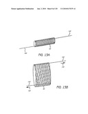 MINIMALLY INVASIVE BREAST LIFT METHOD WITH A SUPERIOR TISSUE SUPPORT AND AN INFERIOR ANCHOR diagram and image