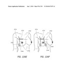 MINIMALLY INVASIVE BREAST LIFT METHOD WITH A SUPERIOR TISSUE SUPPORT AND AN INFERIOR ANCHOR diagram and image