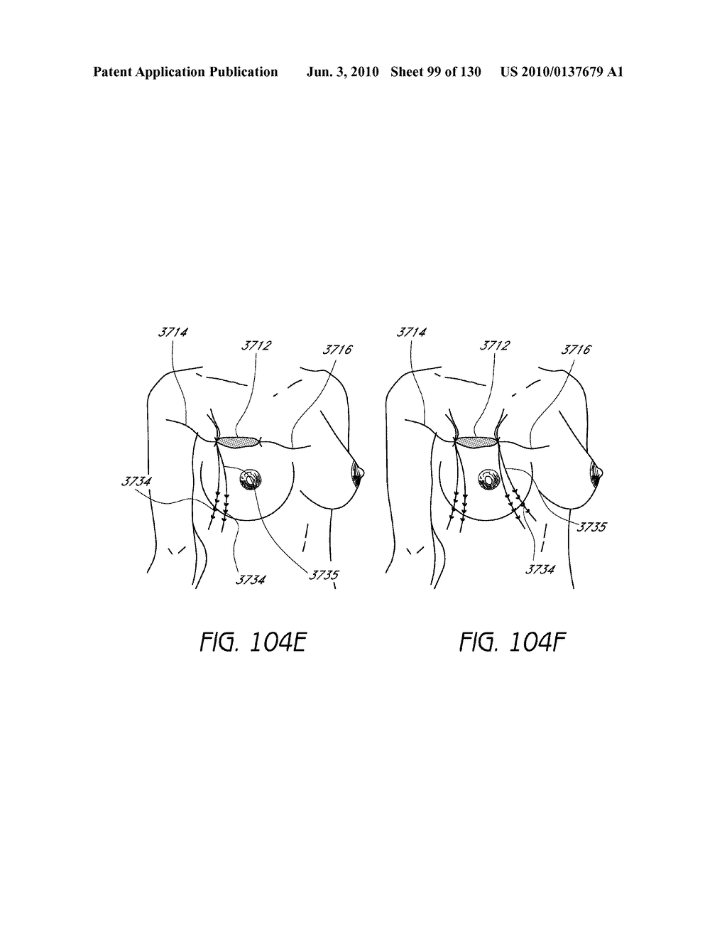 MINIMALLY INVASIVE BREAST LIFT METHOD WITH A SUPERIOR TISSUE SUPPORT AND AN INFERIOR ANCHOR - diagram, schematic, and image 100