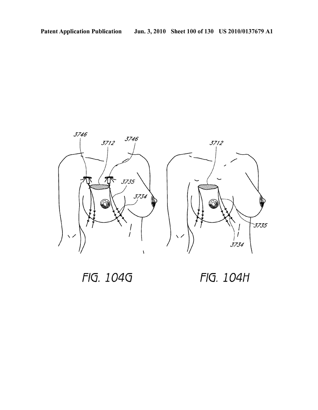 MINIMALLY INVASIVE BREAST LIFT METHOD WITH A SUPERIOR TISSUE SUPPORT AND AN INFERIOR ANCHOR - diagram, schematic, and image 101