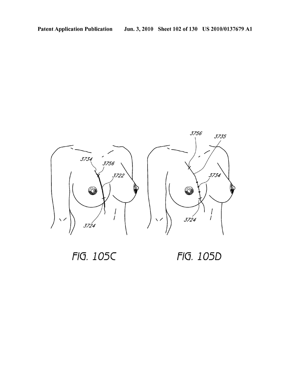 MINIMALLY INVASIVE BREAST LIFT METHOD WITH A SUPERIOR TISSUE SUPPORT AND AN INFERIOR ANCHOR - diagram, schematic, and image 103