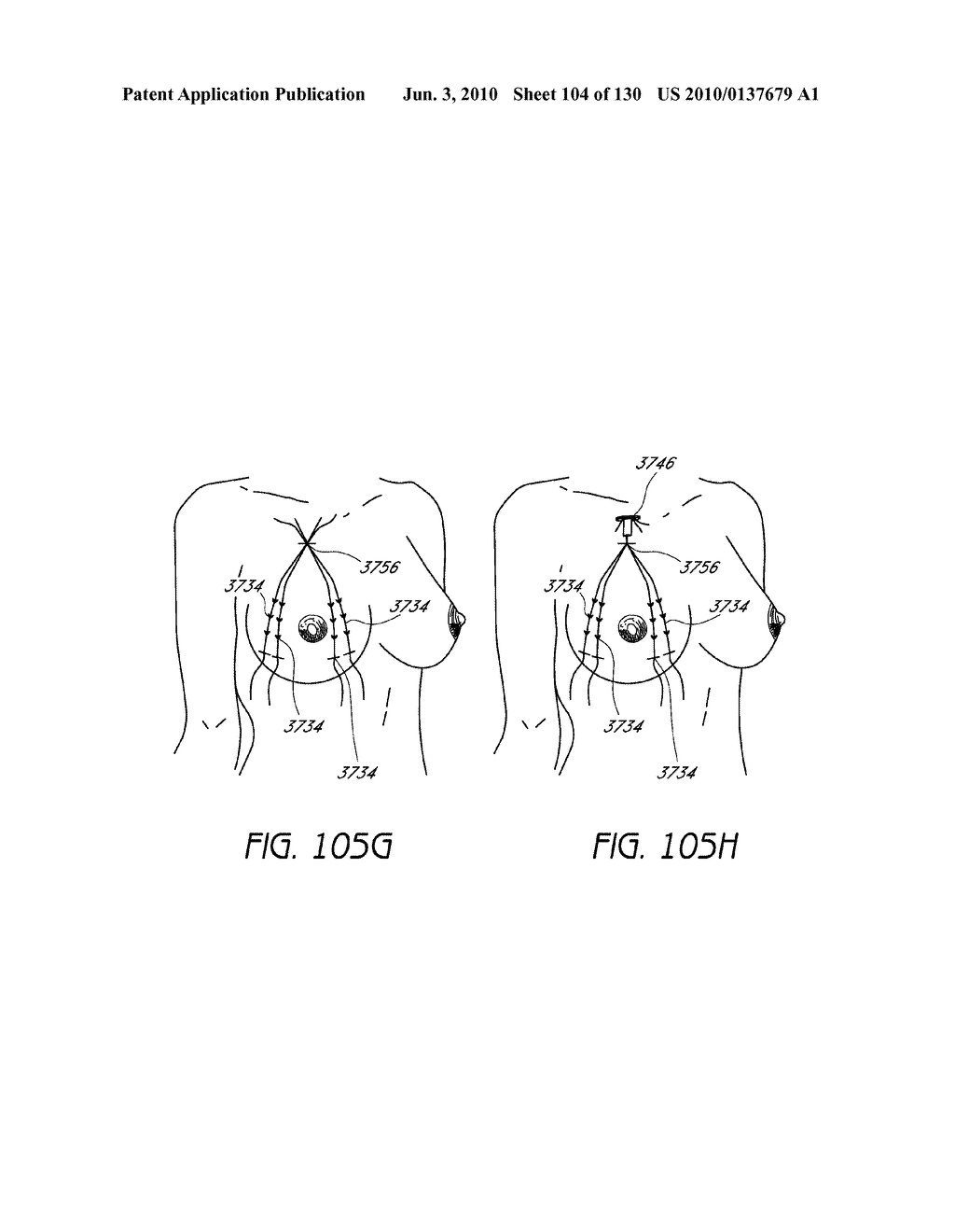 MINIMALLY INVASIVE BREAST LIFT METHOD WITH A SUPERIOR TISSUE SUPPORT AND AN INFERIOR ANCHOR - diagram, schematic, and image 105