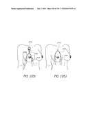 MINIMALLY INVASIVE BREAST LIFT METHOD WITH A SUPERIOR TISSUE SUPPORT AND AN INFERIOR ANCHOR diagram and image