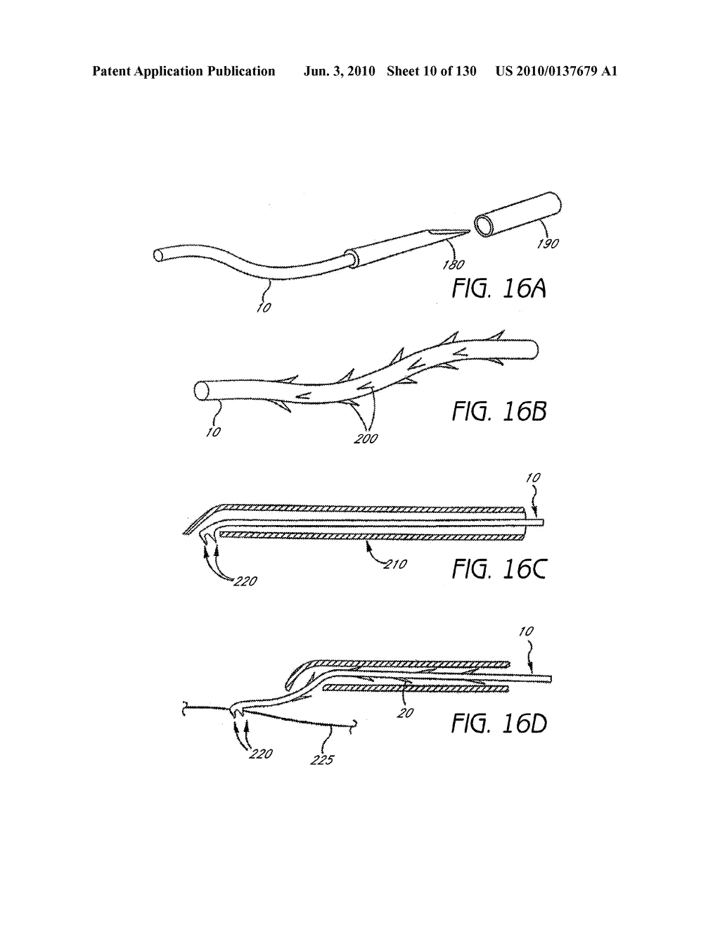 MINIMALLY INVASIVE BREAST LIFT METHOD WITH A SUPERIOR TISSUE SUPPORT AND AN INFERIOR ANCHOR - diagram, schematic, and image 11