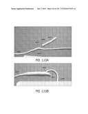 MINIMALLY INVASIVE BREAST LIFT METHOD WITH A SUPERIOR TISSUE SUPPORT AND AN INFERIOR ANCHOR diagram and image