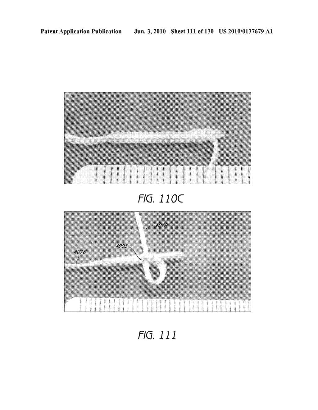 MINIMALLY INVASIVE BREAST LIFT METHOD WITH A SUPERIOR TISSUE SUPPORT AND AN INFERIOR ANCHOR - diagram, schematic, and image 112