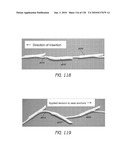 MINIMALLY INVASIVE BREAST LIFT METHOD WITH A SUPERIOR TISSUE SUPPORT AND AN INFERIOR ANCHOR diagram and image