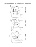 MINIMALLY INVASIVE BREAST LIFT METHOD WITH A SUPERIOR TISSUE SUPPORT AND AN INFERIOR ANCHOR diagram and image