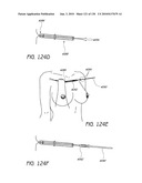 MINIMALLY INVASIVE BREAST LIFT METHOD WITH A SUPERIOR TISSUE SUPPORT AND AN INFERIOR ANCHOR diagram and image