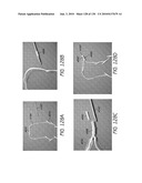 MINIMALLY INVASIVE BREAST LIFT METHOD WITH A SUPERIOR TISSUE SUPPORT AND AN INFERIOR ANCHOR diagram and image