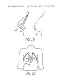 MINIMALLY INVASIVE BREAST LIFT METHOD WITH A SUPERIOR TISSUE SUPPORT AND AN INFERIOR ANCHOR diagram and image