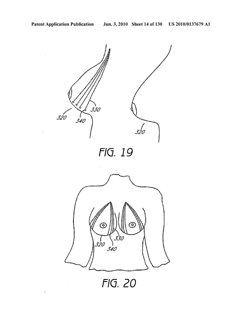 MINIMALLY INVASIVE BREAST LIFT METHOD WITH A SUPERIOR TISSUE SUPPORT AND AN INFERIOR ANCHOR - diagram, schematic, and image 15