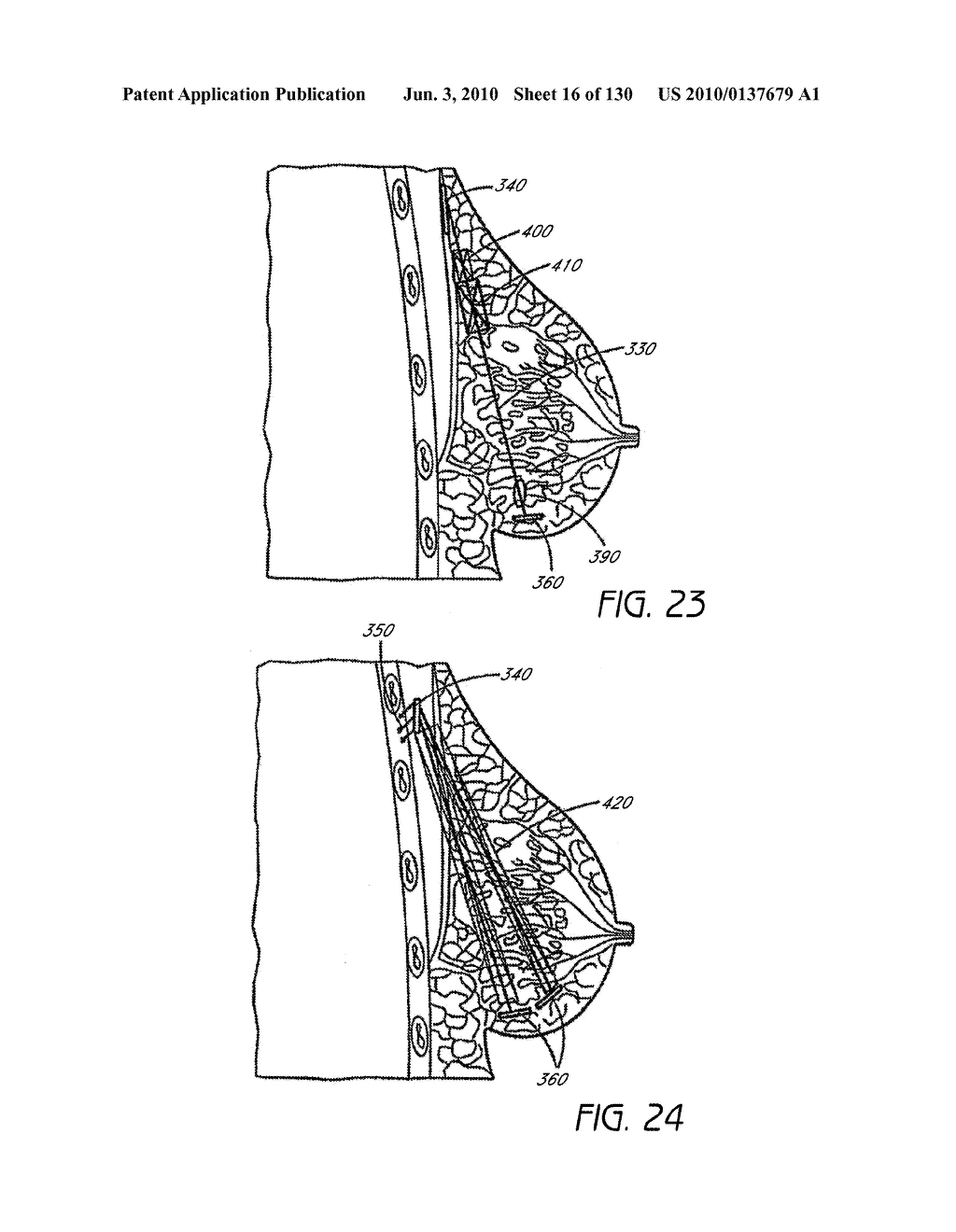 MINIMALLY INVASIVE BREAST LIFT METHOD WITH A SUPERIOR TISSUE SUPPORT AND AN INFERIOR ANCHOR - diagram, schematic, and image 17