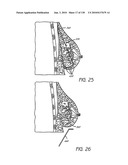 MINIMALLY INVASIVE BREAST LIFT METHOD WITH A SUPERIOR TISSUE SUPPORT AND AN INFERIOR ANCHOR diagram and image