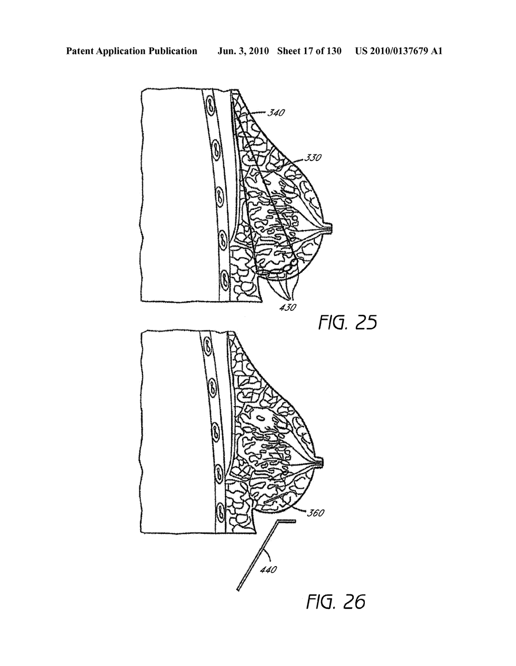 MINIMALLY INVASIVE BREAST LIFT METHOD WITH A SUPERIOR TISSUE SUPPORT AND AN INFERIOR ANCHOR - diagram, schematic, and image 18