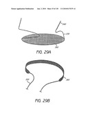 MINIMALLY INVASIVE BREAST LIFT METHOD WITH A SUPERIOR TISSUE SUPPORT AND AN INFERIOR ANCHOR diagram and image