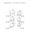 MINIMALLY INVASIVE BREAST LIFT METHOD WITH A SUPERIOR TISSUE SUPPORT AND AN INFERIOR ANCHOR diagram and image