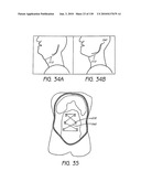 MINIMALLY INVASIVE BREAST LIFT METHOD WITH A SUPERIOR TISSUE SUPPORT AND AN INFERIOR ANCHOR diagram and image