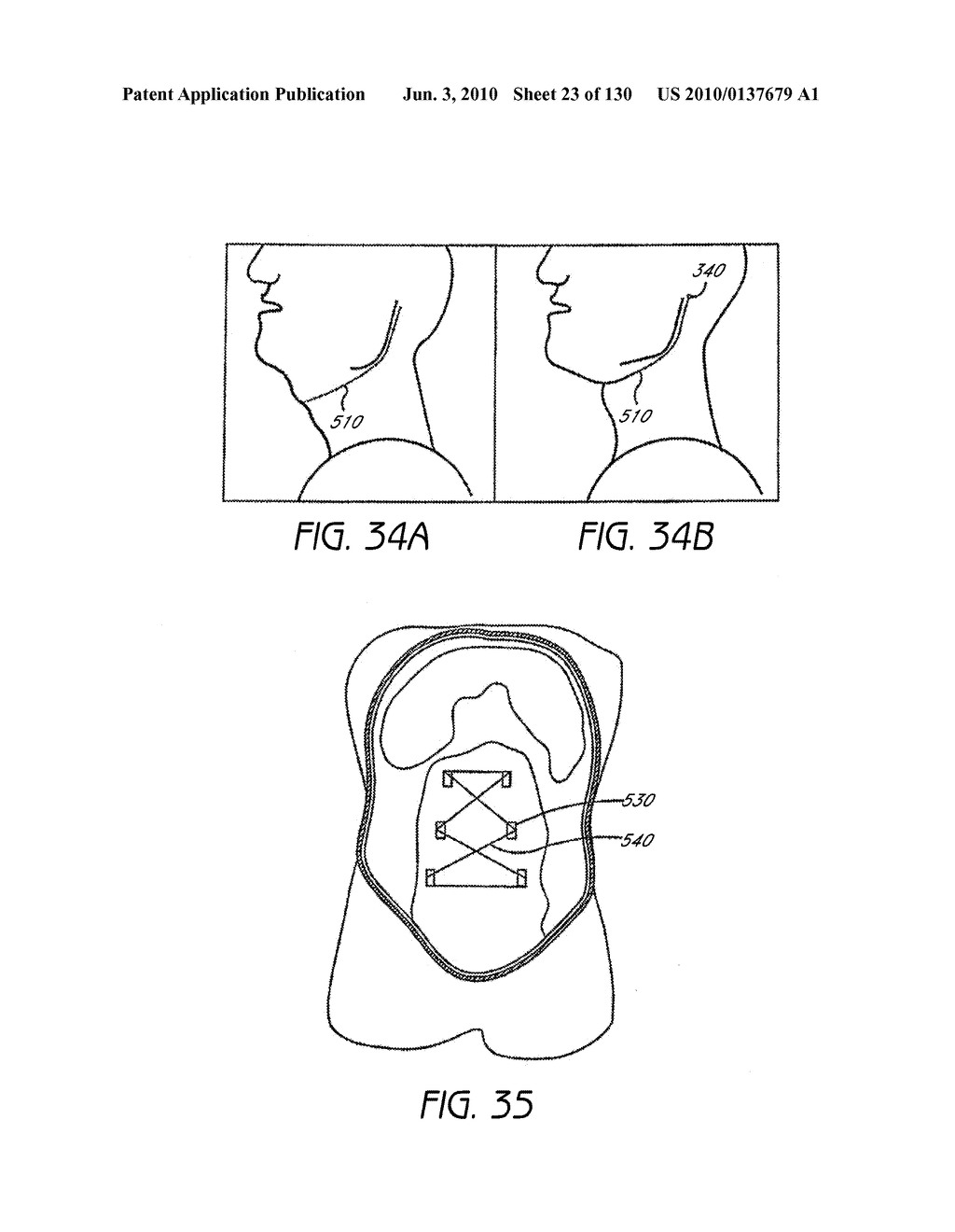 MINIMALLY INVASIVE BREAST LIFT METHOD WITH A SUPERIOR TISSUE SUPPORT AND AN INFERIOR ANCHOR - diagram, schematic, and image 24