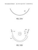 MINIMALLY INVASIVE BREAST LIFT METHOD WITH A SUPERIOR TISSUE SUPPORT AND AN INFERIOR ANCHOR diagram and image