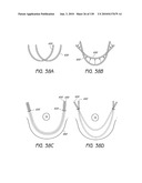 MINIMALLY INVASIVE BREAST LIFT METHOD WITH A SUPERIOR TISSUE SUPPORT AND AN INFERIOR ANCHOR diagram and image