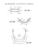 MINIMALLY INVASIVE BREAST LIFT METHOD WITH A SUPERIOR TISSUE SUPPORT AND AN INFERIOR ANCHOR diagram and image