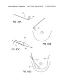 MINIMALLY INVASIVE BREAST LIFT METHOD WITH A SUPERIOR TISSUE SUPPORT AND AN INFERIOR ANCHOR diagram and image