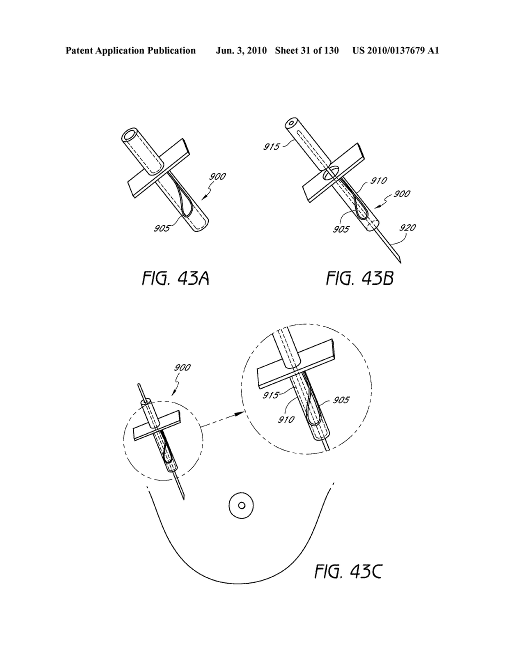 MINIMALLY INVASIVE BREAST LIFT METHOD WITH A SUPERIOR TISSUE SUPPORT AND AN INFERIOR ANCHOR - diagram, schematic, and image 32