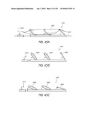 MINIMALLY INVASIVE BREAST LIFT METHOD WITH A SUPERIOR TISSUE SUPPORT AND AN INFERIOR ANCHOR diagram and image