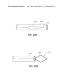 MINIMALLY INVASIVE BREAST LIFT METHOD WITH A SUPERIOR TISSUE SUPPORT AND AN INFERIOR ANCHOR diagram and image