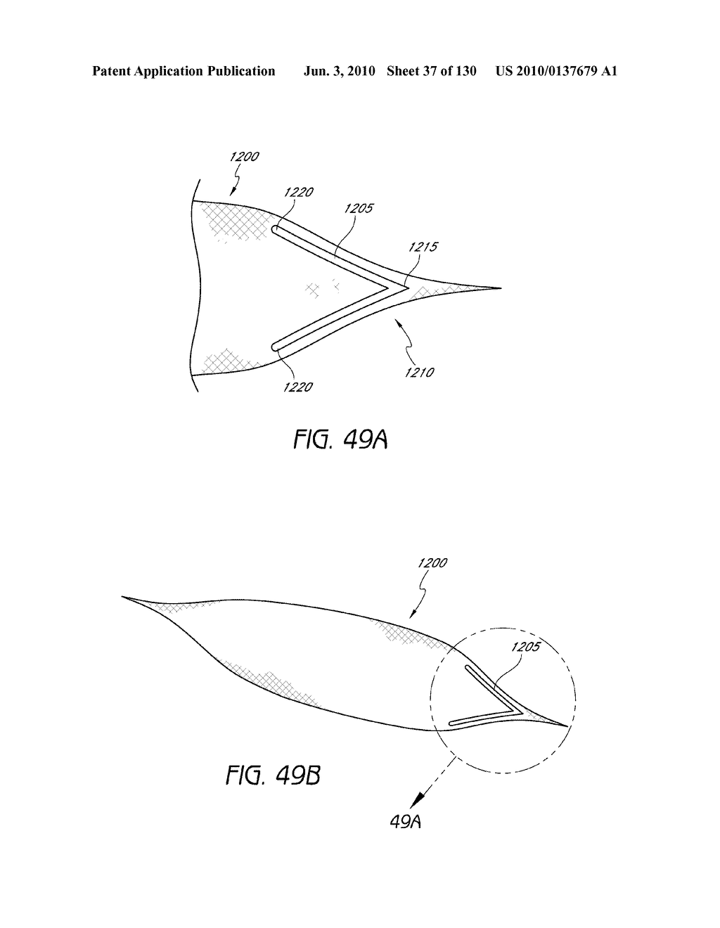 MINIMALLY INVASIVE BREAST LIFT METHOD WITH A SUPERIOR TISSUE SUPPORT AND AN INFERIOR ANCHOR - diagram, schematic, and image 38