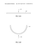 MINIMALLY INVASIVE BREAST LIFT METHOD WITH A SUPERIOR TISSUE SUPPORT AND AN INFERIOR ANCHOR diagram and image