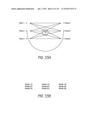 MINIMALLY INVASIVE BREAST LIFT METHOD WITH A SUPERIOR TISSUE SUPPORT AND AN INFERIOR ANCHOR diagram and image