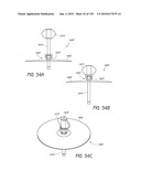 MINIMALLY INVASIVE BREAST LIFT METHOD WITH A SUPERIOR TISSUE SUPPORT AND AN INFERIOR ANCHOR diagram and image