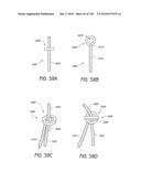 MINIMALLY INVASIVE BREAST LIFT METHOD WITH A SUPERIOR TISSUE SUPPORT AND AN INFERIOR ANCHOR diagram and image