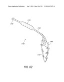 MINIMALLY INVASIVE BREAST LIFT METHOD WITH A SUPERIOR TISSUE SUPPORT AND AN INFERIOR ANCHOR diagram and image