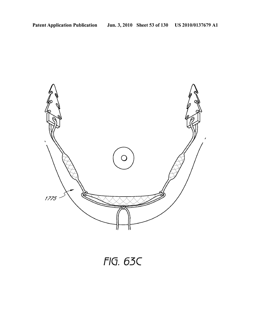 MINIMALLY INVASIVE BREAST LIFT METHOD WITH A SUPERIOR TISSUE SUPPORT AND AN INFERIOR ANCHOR - diagram, schematic, and image 54