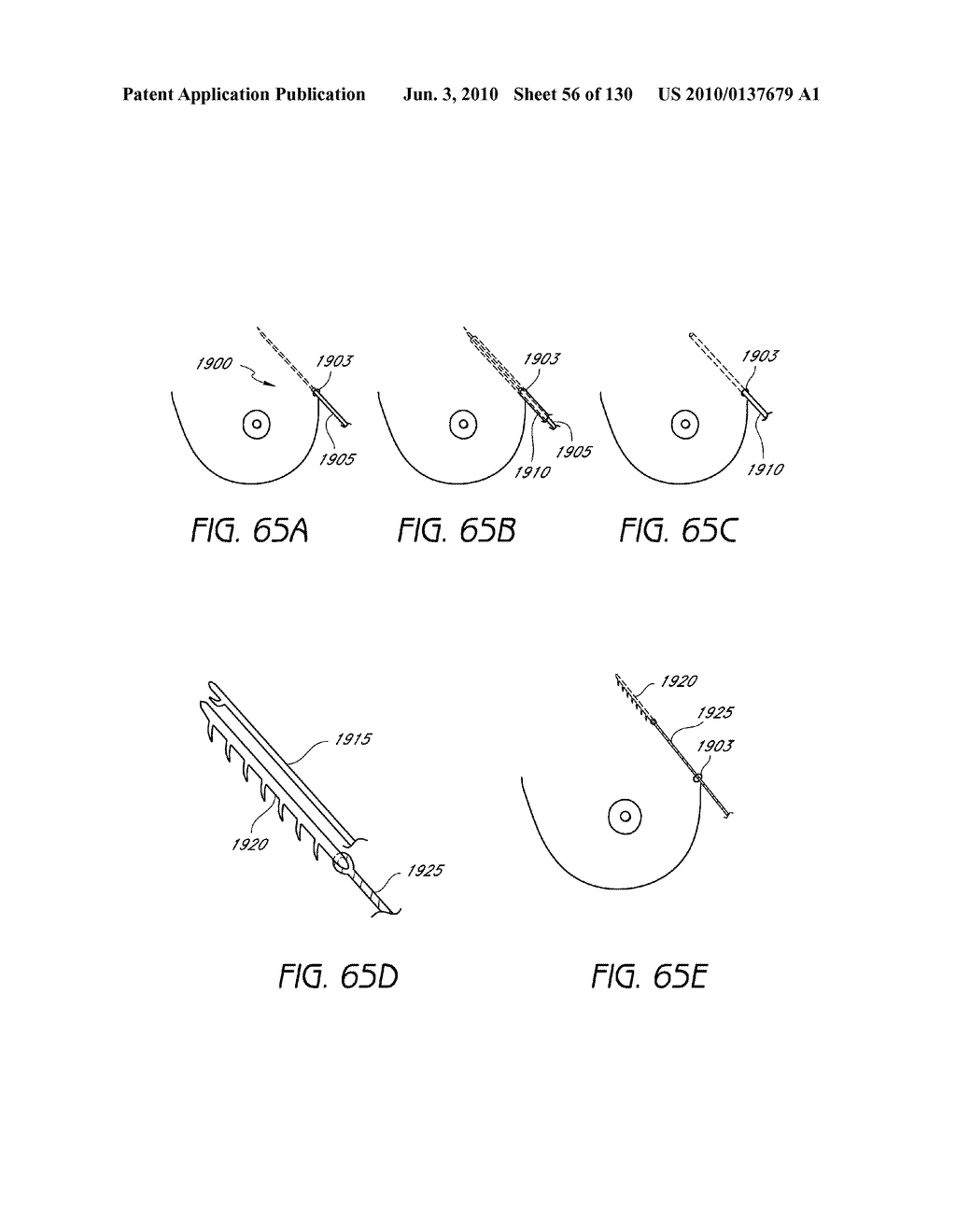 MINIMALLY INVASIVE BREAST LIFT METHOD WITH A SUPERIOR TISSUE SUPPORT AND AN INFERIOR ANCHOR - diagram, schematic, and image 57