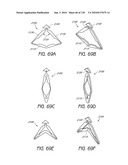 MINIMALLY INVASIVE BREAST LIFT METHOD WITH A SUPERIOR TISSUE SUPPORT AND AN INFERIOR ANCHOR diagram and image