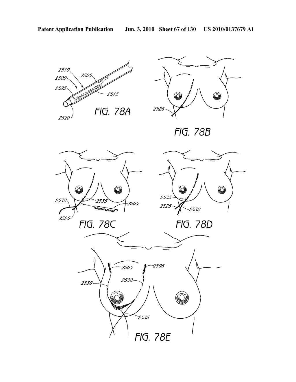 MINIMALLY INVASIVE BREAST LIFT METHOD WITH A SUPERIOR TISSUE SUPPORT AND AN INFERIOR ANCHOR - diagram, schematic, and image 68