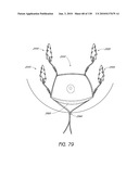 MINIMALLY INVASIVE BREAST LIFT METHOD WITH A SUPERIOR TISSUE SUPPORT AND AN INFERIOR ANCHOR diagram and image